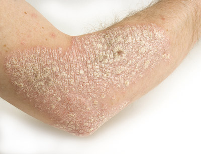 studies have shown free is real connection between psoriasis and diet,