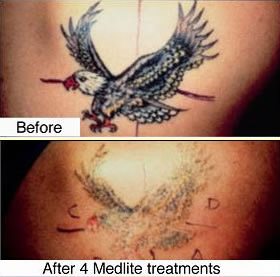tattoo removal lasers