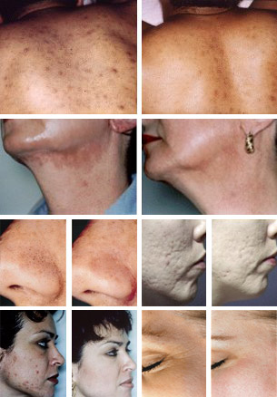 Before & After Treatment Photos. Provided by: Radiance Medspa Wheaton, IL