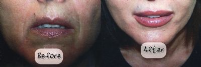 JUVEDERM® Before & After Photo