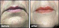 JUVEDERM® Before & After Photo