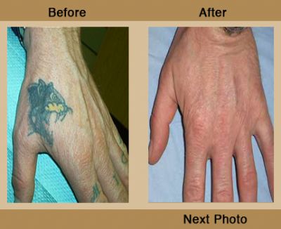 Dermatology Photo Gallery Before and After Photos