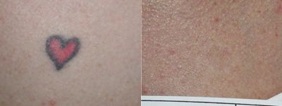 Tatto Removal on Laser Tattoo Removal Before   After Photo