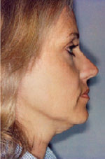 Before Thermage Treatment