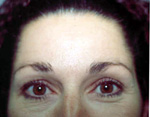 After BOTOX® Cosmetic Treatment