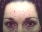Before BOTOX® Cosmetic Treatment