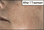 After Chemical Peel Treatment