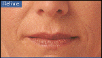 Before Collagen Injection Treatment