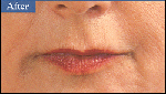 After Collagen Injection Photos