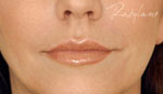after lip enhancement - Restylane
