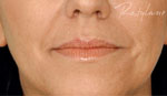 before lip enhancement - Restylane
