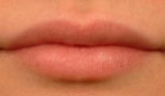 After Radiesse - Lip Augmentation